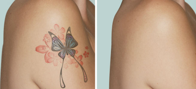 Tattoo Removal Bangalore | Tattoo Removal Price Bangalore | Tattoo Removal