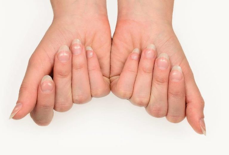 Decoding Beau s Lines Causes Symptoms And Treatment