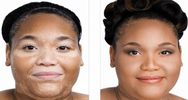 Conceal Vitiligo with Makeup 