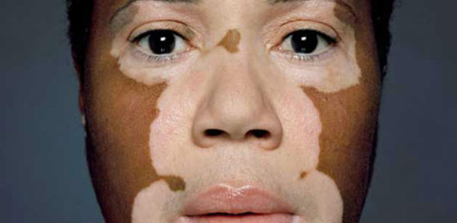 Vitiligo Prevention