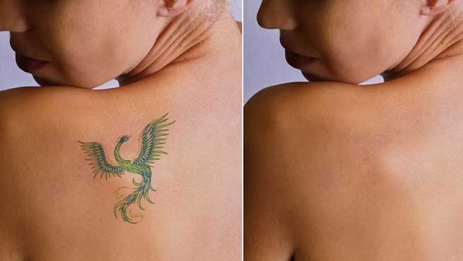 Are There Any Side Effects Of Tattoo Removal?