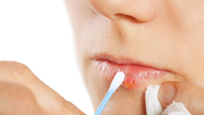 Useful Remedies of Cold Sores