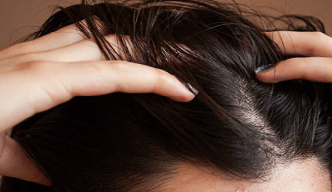 Treat Your Hair With Kalonji Oil For Preventing Hair Loss