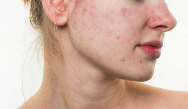 acne-gel-benefits-1