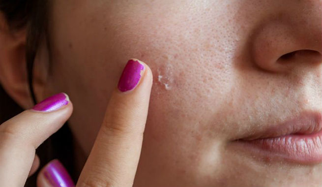 Learn Different Tricks To Cover Up Your Breakouts Easily