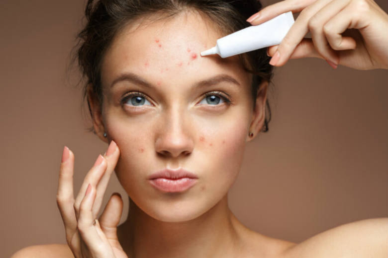 Glycolic Acid For Acne Scars And Pimple Marks