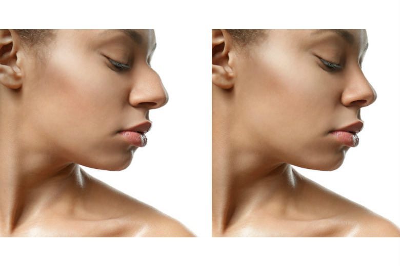 African American Rhinoplasty - Before & After