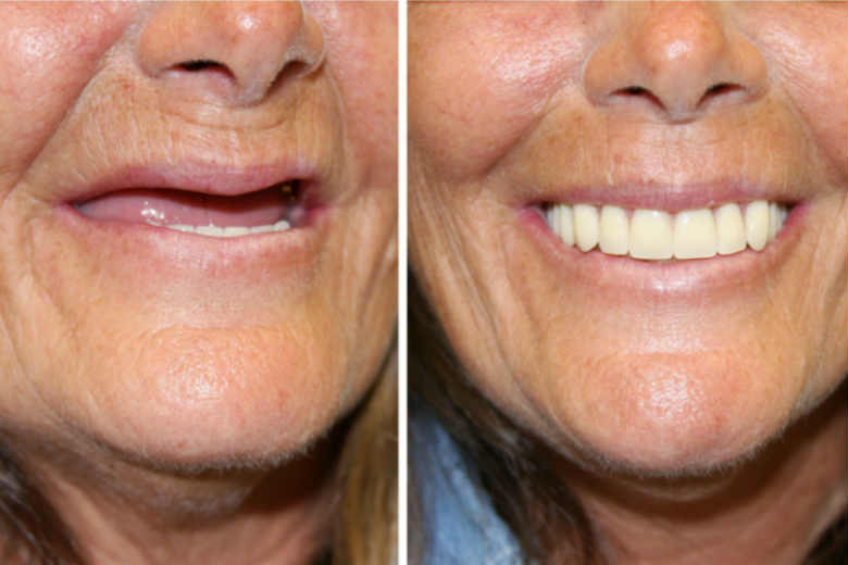 All-On-4 Dental Implants - Before & After
