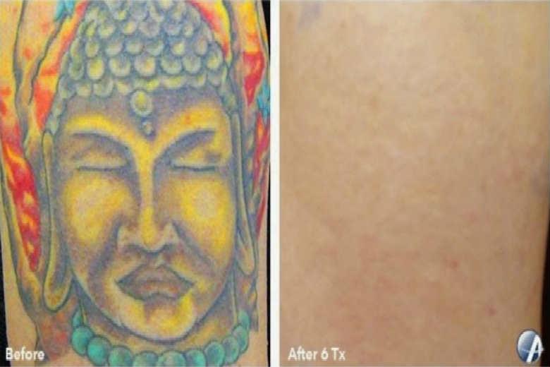 Astanza Trinity - Tattoo Removal Solution (Before & After)