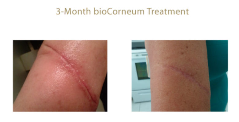 Biocorneum For Stubborn Scars - Before and After