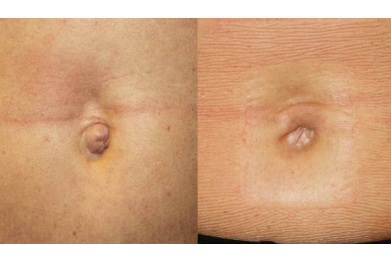 Belly Button Surgery - Before & After