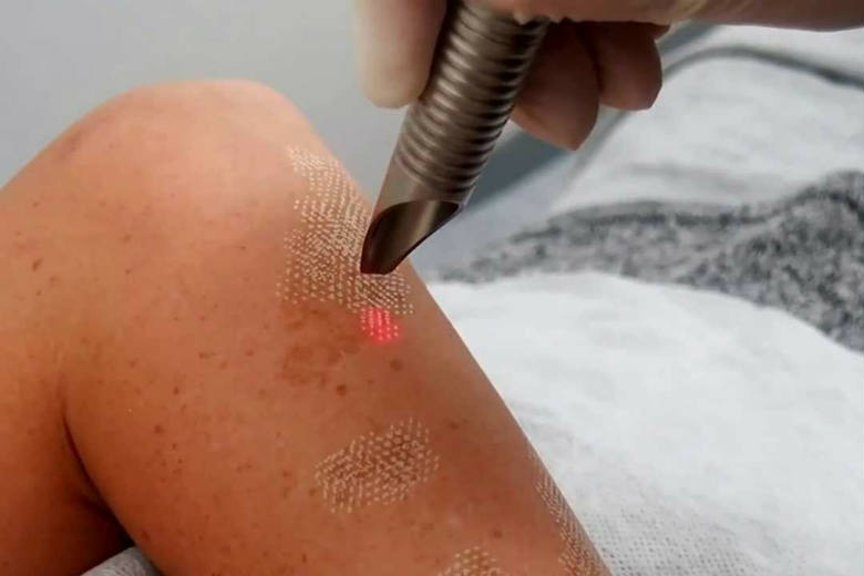 Laser Birthmark Removal