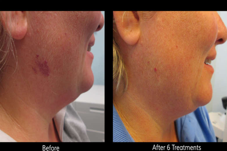 Laser Birthmark Removal (Before & After)