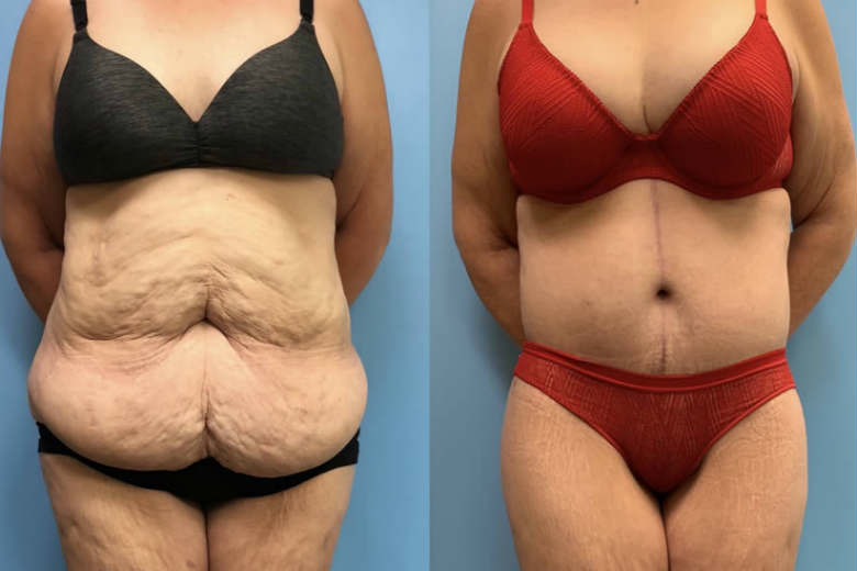 Body Lift Surgery (Before & After)