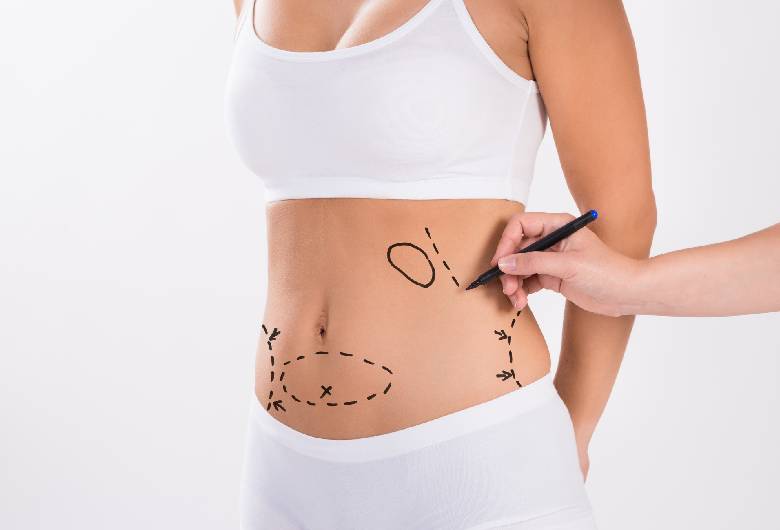 Is Liposuction Right for You?