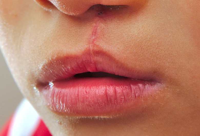 what causes a cleft lip